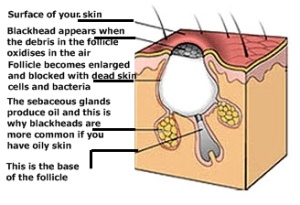 blackheads