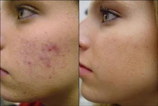 adult facial acne