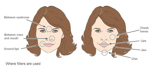 dermal fillers