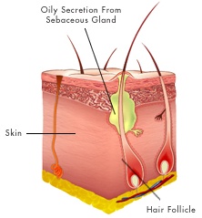 pimple formation