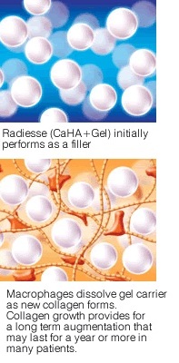 radiesse principles
