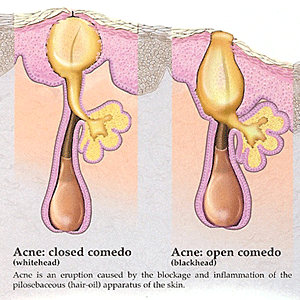 acne skin